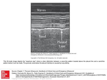 This M-mode image depicts the seashore sign where a clear distinction between a wave-like pattern located above the pleural line and a sand-like pattern.