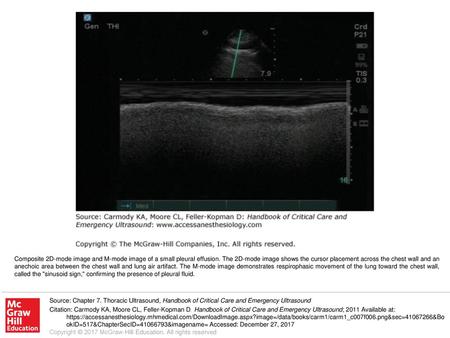 Composite 2D-mode image and M-mode image of a small pleural effusion