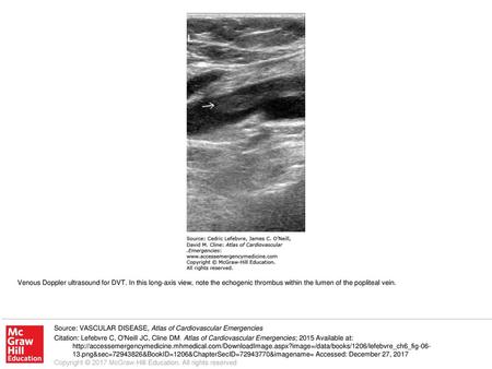 Venous Doppler ultrasound for DVT