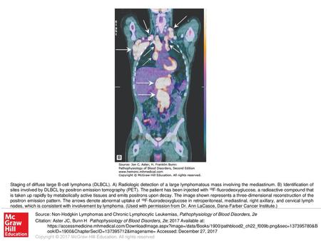 Staging of diffuse large B-cell lymphoma (DLBCL)