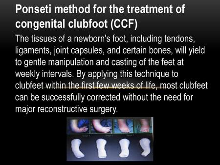 Ponseti method for the treatment of congenital clubfoot (CCF)