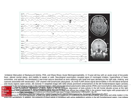 The presence of PDA and depression of beta and alpha activities is supportive of underlying structural abnormalities (both gray and white matter) in the.