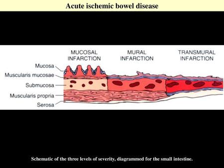 Acute ischemic bowel disease