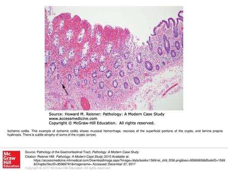 Ischemic colitis. This example of ischemic colitis shows mucosal hemorrhage, necrosis of the superficial portions of the crypts, and lamina propria hyalinosis.