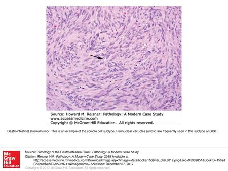 Gastrointestinal stromal tumor