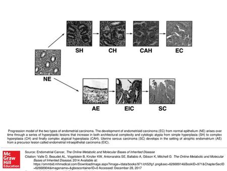 Progression model of the two types of endometrial carcinoma