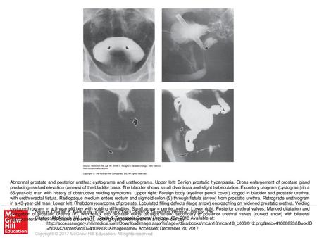 Abnormal prostate and posterior urethra: cystograms and urethrograms