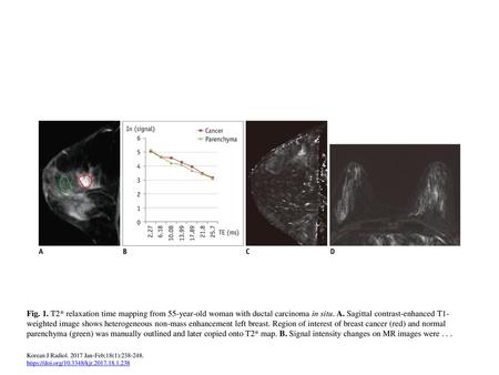 Fig. 1. T2* relaxation time mapping from 55-year-old woman with ductal carcinoma in situ. A. Sagittal contrast-enhanced T1-weighted image shows heterogeneous.