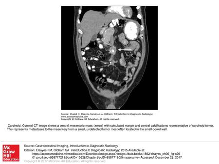 Carcinoid. Coronal CT image shows a central mesenteric mass (arrow) with spiculated margin and central calcifications representative of carcinoid tumor.