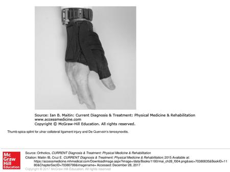 Thumb spica splint for ulnar collateral ligament injury and De Quervain’s tenosynovitis. Source: Orthotics, CURRENT Diagnosis & Treatment: Physical Medicine.