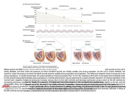Measurement and Mechanism of Pulsus Paradoxus A, The examiner inflates the sphygmomanometer cuff fully, listens for Korotkoff sounds as the cuff is slowly.
