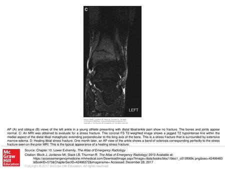 AP (A) and oblique (B) views of the left ankle in a young athlete presenting with distal tibial/ankle pain show no fracture. The bones and joints appear.