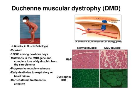 Duchenne muscular dystrophy (DMD)