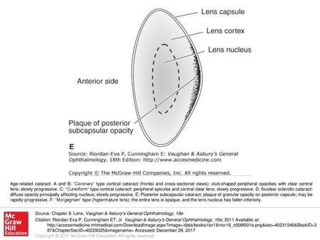 Age-related cataract. A and B: “Coronary” type cortical cataract (frontal and cross-sectional views): club-shaped peripheral opacities with clear central.