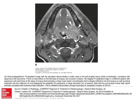 (A) Axial postgadolinium Tl-weighted image with fat saturation demonstrates a bulky mass in the left tonsillar fossa (white arrowheads), consistent with.