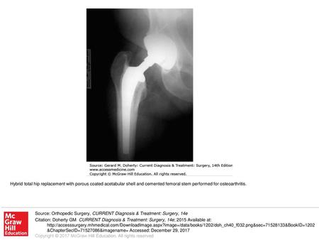 Hybrid total hip replacement with porous coated acetabular shell and cemented femoral stem performed for osteoarthritis. Source: Orthopedic Surgery, CURRENT.