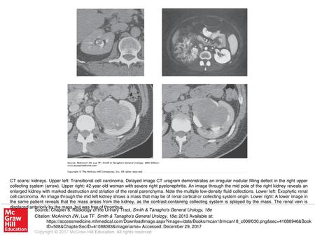 CT scans: kidneys. Upper left: Transitional cell carcinoma