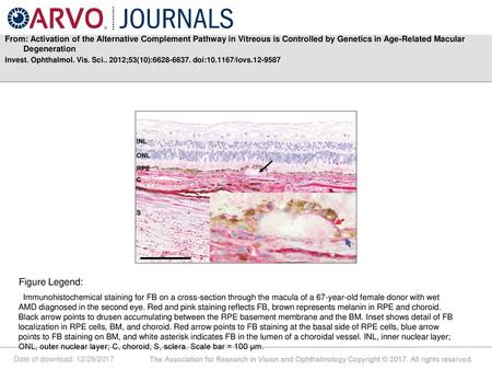 From: Activation of the Alternative Complement Pathway in Vitreous is Controlled by Genetics in Age-Related Macular Degeneration Invest. Ophthalmol. Vis.