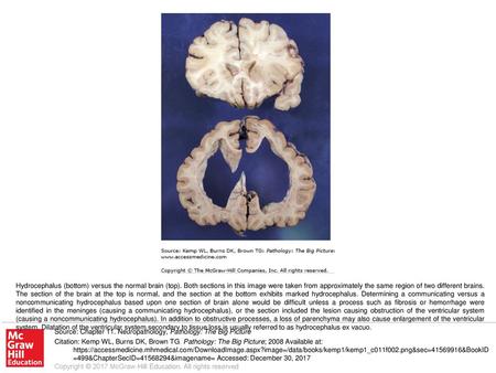 Hydrocephalus (bottom) versus the normal brain (top)