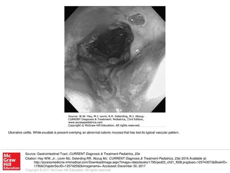 Ulcerative colitis. White exudate is present overlying an abnormal colonic mucosa that has lost its typical vascular pattern. Source: Gastrointestinal.