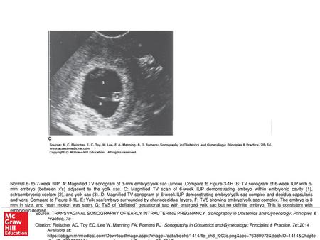 Normal 6- to 7-week IUP. A: Magnified TV sonogram of 3-mm embryo/yolk sac (arrow). Compare to Figure 3-1H. B: TV sonogram of 6-week IUP with 6-mm embryo.