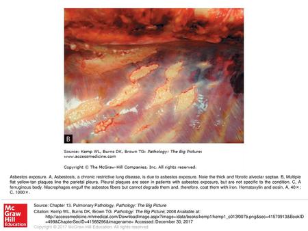 Asbestos exposure. A, Asbestosis, a chronic restrictive lung disease, is due to asbestos exposure. Note the thick and fibrotic alveolar septae. B, Multiple.