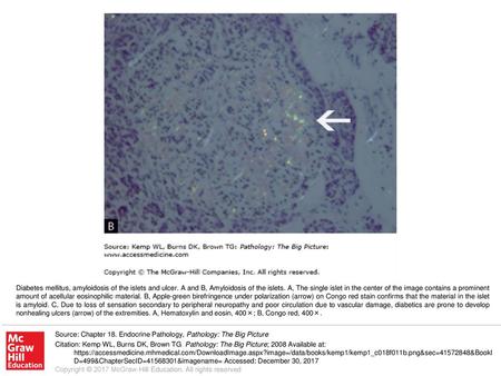 Diabetes mellitus, amyloidosis of the islets and ulcer