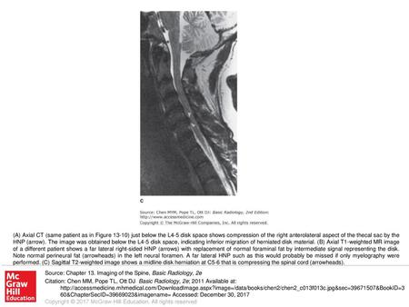 (A) Axial CT (same patient as in Figure 13-10) just below the L4-5 disk space shows compression of the right anterolateral aspect of the thecal sac by.