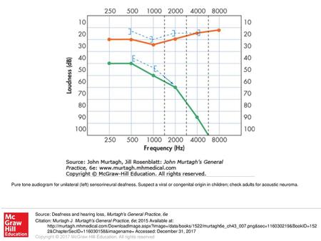 Pure tone audiogram for unilateral (left) sensorineural deafness