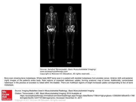 Bone scan showing bone metastases