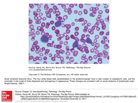 Acute lymphoid leukemia (ALL)