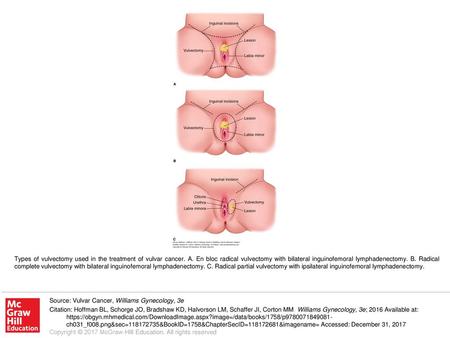 Types of vulvectomy used in the treatment of vulvar cancer. A