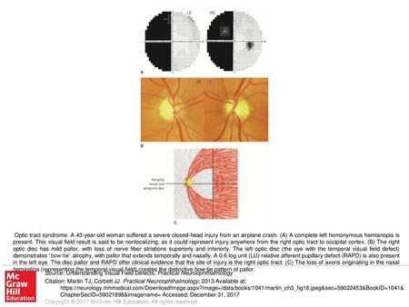 Optic tract syndrome. A 43-year-old woman suffered a severe closed-head injury from an airplane crash. (A) A complete left homonymous hemianopia is present.