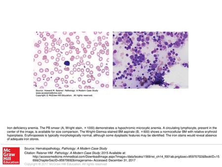 Iron deficiency anemia