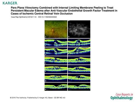 Pars Plana Vitrectomy Combined with Internal Limiting Membrane Peeling to Treat Persistent Macular Edema after Anti-Vascular Endothelial Growth Factor.