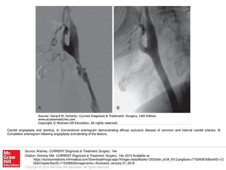 Carotid angioplasty and stenting