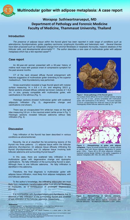 Multinodular goiter with adipose metaplasia: A case report