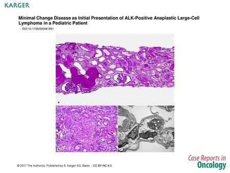 Minimal Change Disease as Initial Presentation of ALK-Positive Anaplastic Large-Cell Lymphoma in a Pediatric Patient - DOI:10.1159/000481851 Fig. 1. Renal.