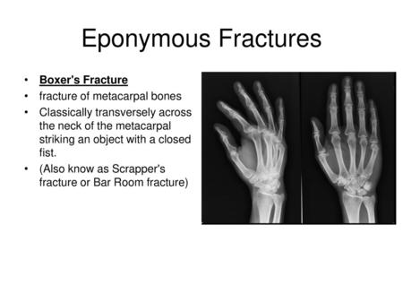 Eponymous Fractures Boxer's Fracture fracture of metacarpal bones