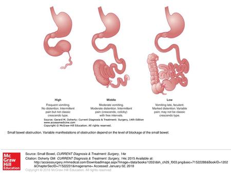 Small bowel obstruction