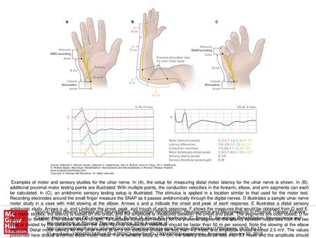 Examples of motor and sensory studies for the ulnar nerve