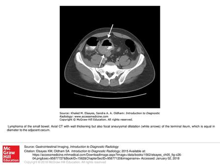 Lymphoma of the small bowel