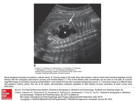 Renal dysplasia secondary to posterior urethral valves