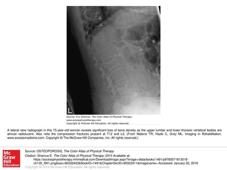 A lateral view radiograph in this 75-year-old woman reveals significant loss of bone density as the upper lumbar and lower thoracic vertebral bodies are.