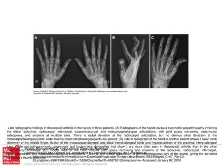 Late radiographic findings in rheumatoid arthritis in the hands of three patients. (A) Radiographs of the hands reveal a symmetric polyarthropathy involving.