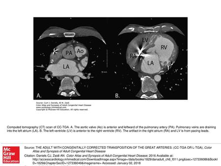 Computed tomography (CT) scan of CC-TGA. A