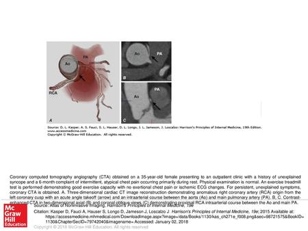 Coronary computed tomography angiography (CTA) obtained on a 35-year-old female presenting to an outpatient clinic with a history of unexplained syncope.