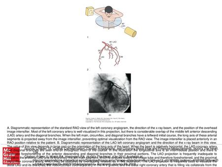 A. Diagrammatic representation of the standard RAO view of the left coronary angiogram, the direction of the x-ray beam, and the position of the overhead.