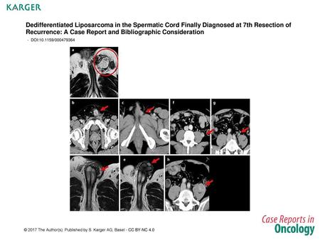 Dedifferentiated Liposarcoma in the Spermatic Cord Finally Diagnosed at 7th Resection of Recurrence: A Case Report and Bibliographic Consideration - DOI:10.1159/000479364.