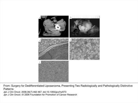 Figure 1. (a) Regional computed tomography (CT) showed two distinctive patterns of low and iso density mass. (b) Gross finding of the resected specimen.